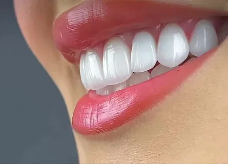 Дизайн Hollywood Smile